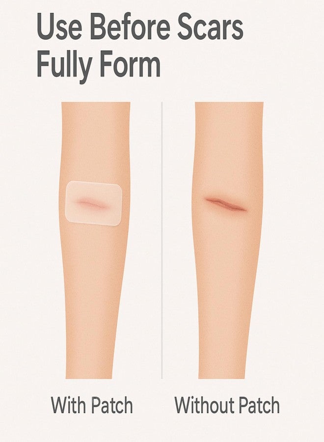 PUREEASE Clear Scar Sheets – 10 Pieces – Skin Patches for Face and Body – Use Before Scars Fully Form – Prevent and Reduce Scars from Acne, Scalds, Burns, Cuts, Abrasions – Thin, Flexible, Waterproof, Gentle - Image 3